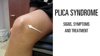 Plica syndrome Signs symptoms and treatment of this uncomfortable knee pain [upl. by Nabru]